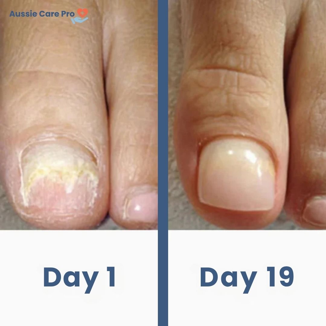 Laser-Gerät zur Nagelpilzbehandlung – sichere und schmerzfreie Therapie