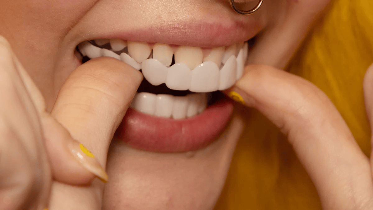 Snap-on-Smile-Veneers (Ober- und Unterkiefer)