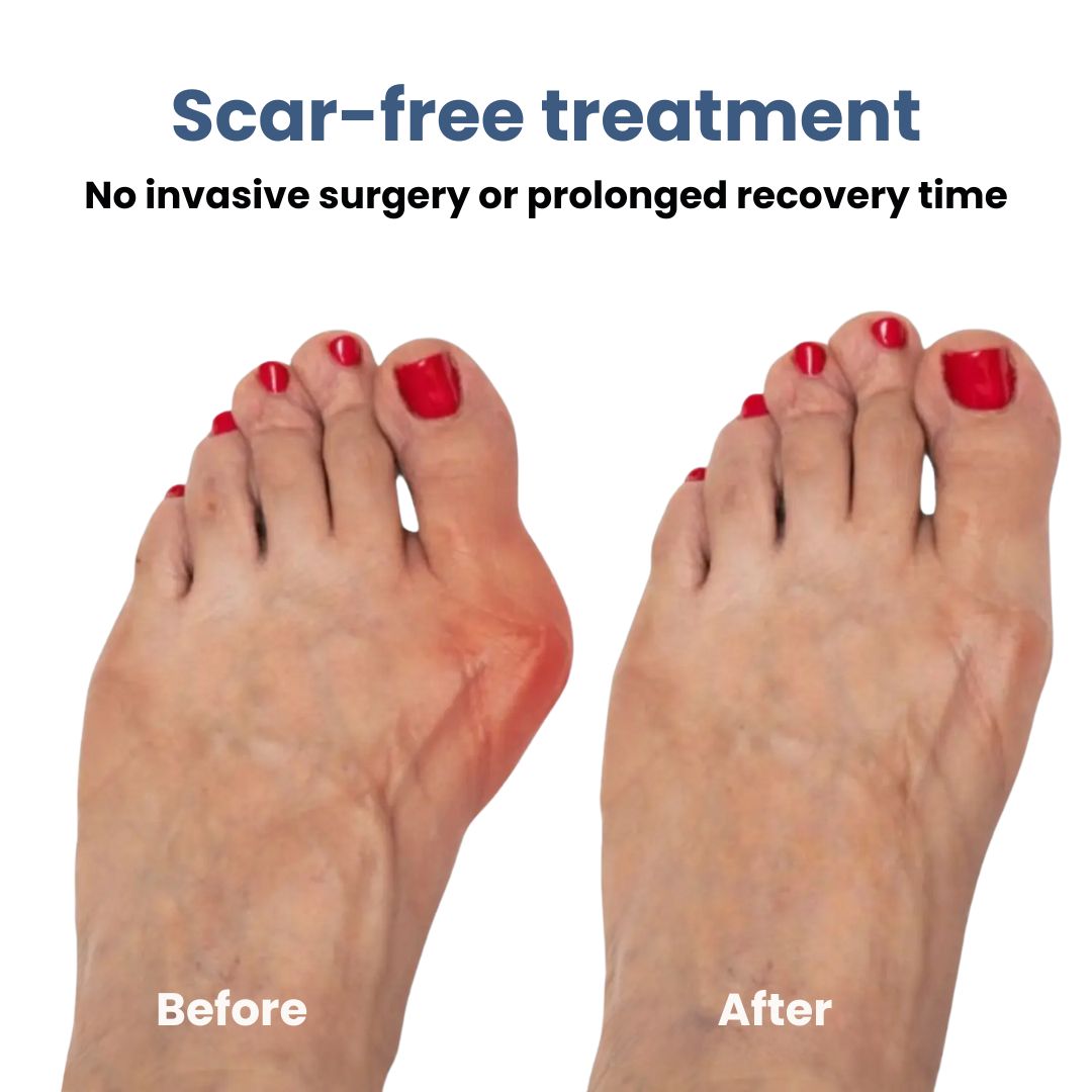 Hallux-valgus-Korrekturbandage