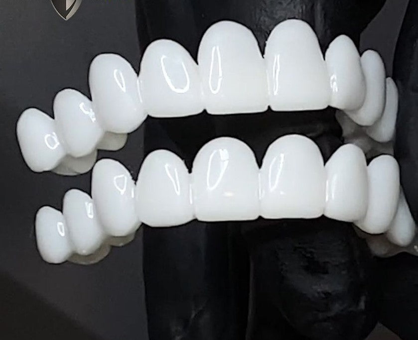 Kosmetische Snap-on-Veneers – Sofortige Lächeln-Abdeckung bei Unvollkommenheiten