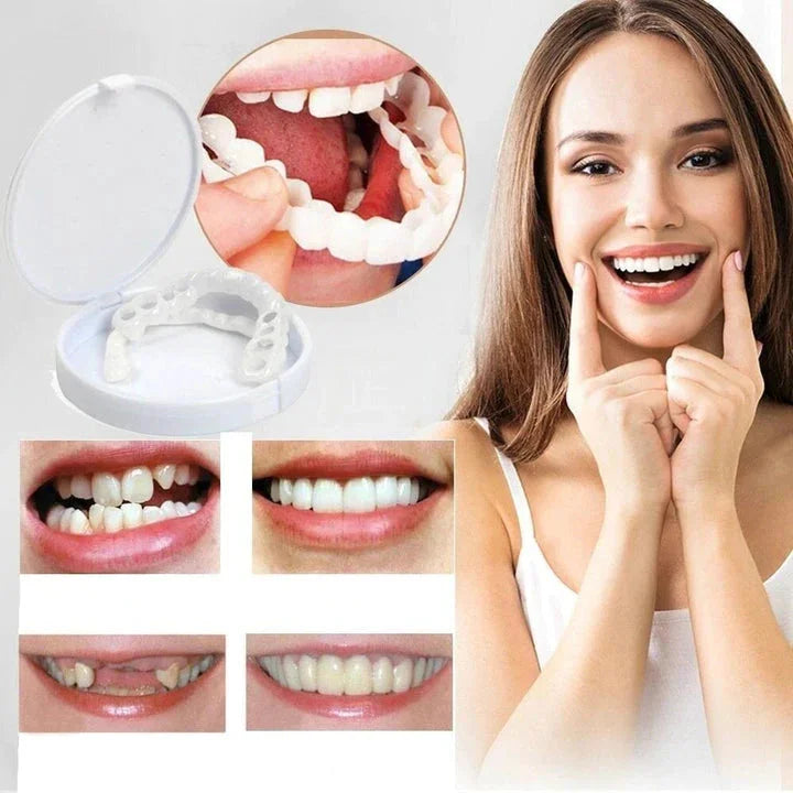 Snap-on-Smile-Veneers (Ober- und Unterkiefer)